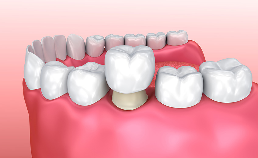 Dental Crowns vs. Dental Bridges: Which is Right For You?