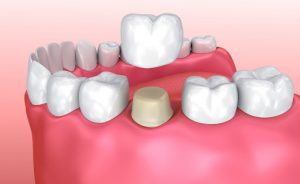 Who Can Benefit From Dental Crowns