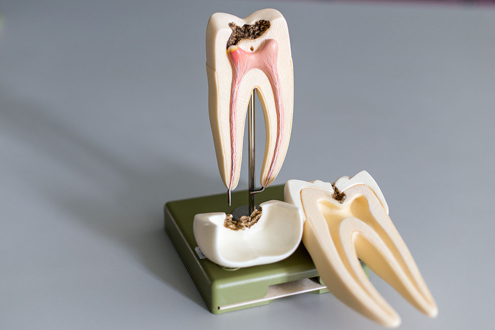 root canal treatment Concord, NC